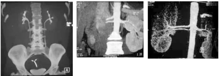 Figura 1. Tomografía helicoidal con reconstrucción vascular y del tracto urinario, estas imágenes pueden reemplazar a la urografía excretora y arte-