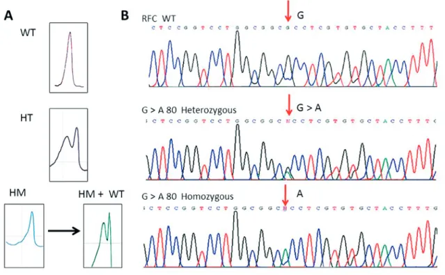 Figure 1. RFC gene analysis by  A: DHPLC showing a single peak for the homozygous wildtype or mutant, whereas multiple peaks 