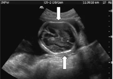 Figure 3. Figure 3. Cranial depression.