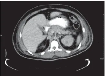 Figura 1. TAC de abdomen con contraste VO. Se aprecia pancreati-
