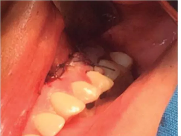 Figura 7.  Cierre hermético del abordaje y de la mucosa donde origi- origi-nalmente estaba el tercer molar desplazado.