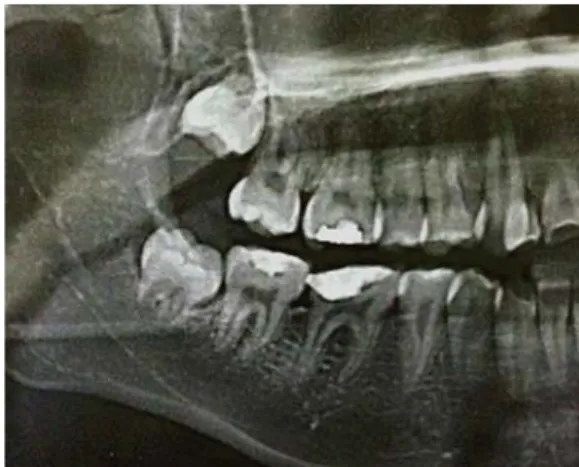 Figura 2. Caso 1. Ortopantomografía donde se observa tercer molar  inferior derecho retenido en proceso de formación radicular.