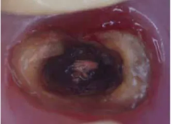 Figura 1.  Premolar sin poste y corona.