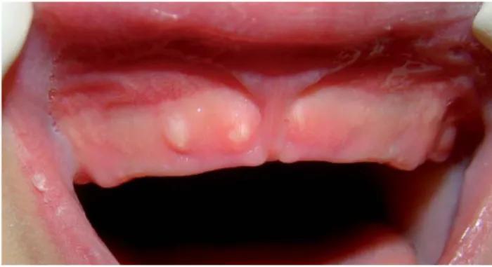 Figura 2. Quistes gingivales.