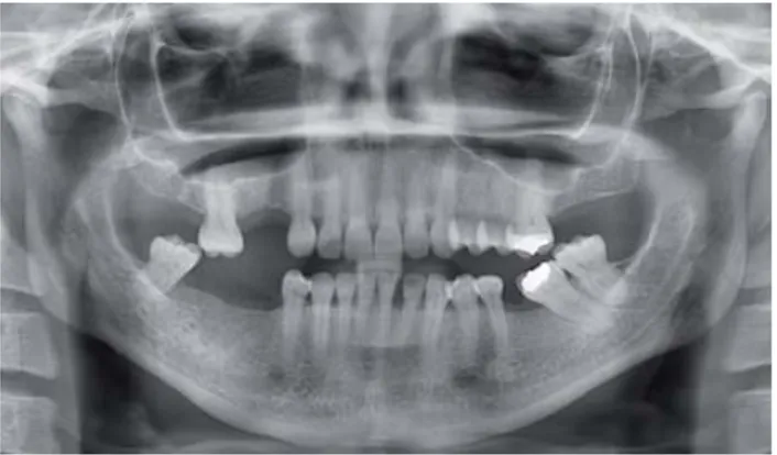 Figura 1. Radiografía panorámica inicial.