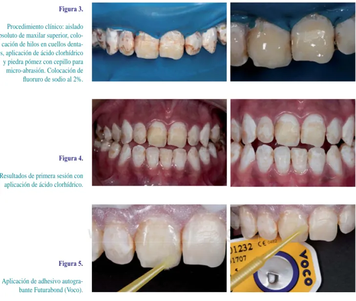 Figura 3.  Procedimiento clínico: aislado  absoluto de maxilar superior,  colo-cación de hilos en cuellos  denta-les, aplicación de ácido clorhídrico 