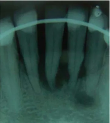 Figura 6. Desgaste interproximal de los dientes móviles usándose una