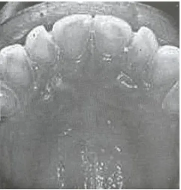 Figura 3. Erosión ácida y abrasión mecánica extensa de esmalte y dentina con caries secundaria en zona vestibular anterior de la arcada inferior