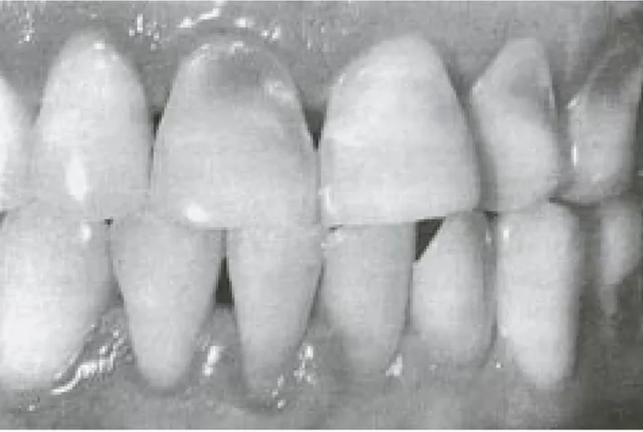 Figura 5. Erosión ácida de esmalte y dentina. (En: Atlas de odontolo- odontolo-gía estética de Schmidseder, 1999)