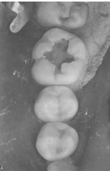 Figura 9A. Colocación de solución reveladora-indicadora de caries. Figura 9B. Vista oclusal de los premolares y molar con las preparacio- preparacio-nes-perforaciones realizadas listas para obturar.