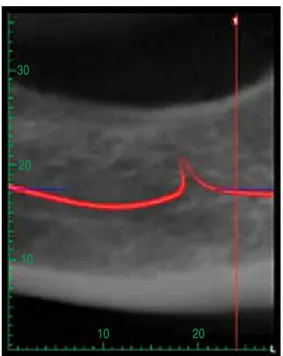 Figura 1:  Corte axial en paciente edéntulo.