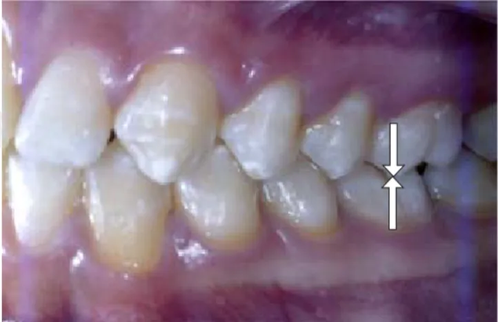 Figura 1. Clase 1 molar.