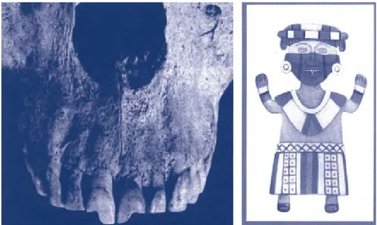 Figura 1. (Izquierda). Limadura dentaria