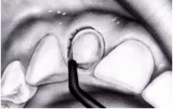 Figura 15. Usando un electrodo recto se detiene la he- he-morragia del surco gingival