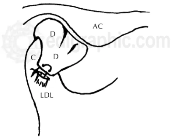 Figura 1. Muestra la relación cóndilo-discal normal y la relación cóndilo- cóndilo-discal secundaria a un proceso de DIATM con desplazamiento anteromedial del disco y formación de adherencias LDL = ligamento discal lateral, C = cóndilo, D = disco articular
