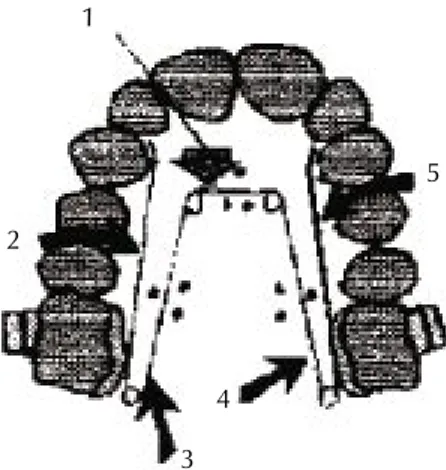 Figura 1. Componentes del aparato. 1: puente anterior, 2: brazo lateral