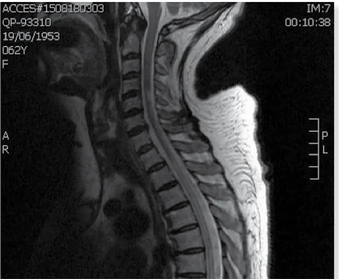 Figura 2.  Imagen de resonancia magnética nuclear de médula espinal cervical y torácica alta en corte sagital en  secuencia T2 en la que se aprecia una pequeña lesión hiperintensa cervical posterior y otra longitudinalmente 