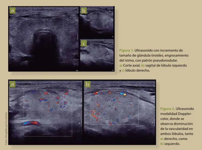 Figura 1.  Ultrasonido con incremento de  tamaño de glándula tiroides, engrosamiento  del istmo, con patrón pseudonodular