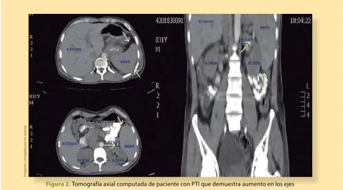 Figura 2. Tomografía axial computada de paciente con PTI que demuestra aumento en los ejes  mayores del bazo (flecha)