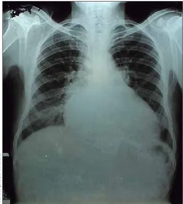 figura 4.  Radiografía de Tórax de un caso de enfermedad  de Chagas crónico con cardiomegalia grado IV y congestión 