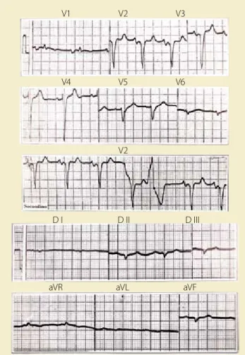 figura 5.  Electrocardiograma del mismo caso con crecimiento  de las cuatro cavidades y extrasístoles ventriculares aisladas.