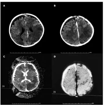 Figura 11.  Tomografía axial computarizada (TAC)  que muestra hematoma subdural e infarto cerebral