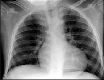 figura 1.  Radiografía de tórax al ingreso del pacien- pacien-te, que muestra silueta cardiaca en forma de “bota” o  “zueco”.