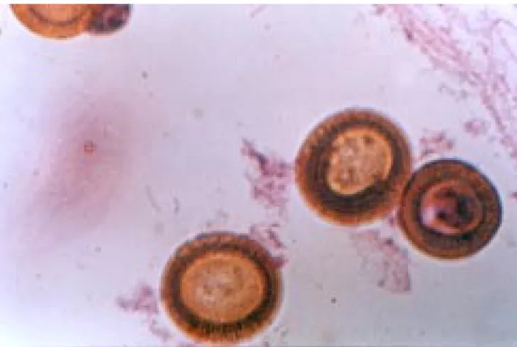 Figura 5. Taenia solium se observa principalmente el escólex con