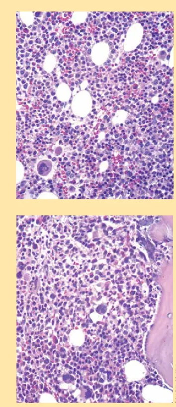 Figura 1a y 1b.  Aspirado de médula ósea: medula ósea  hipercelular (celularidad del 80%) con necrosis focal,  detención de la diferenciación eosinofílica en la serie 