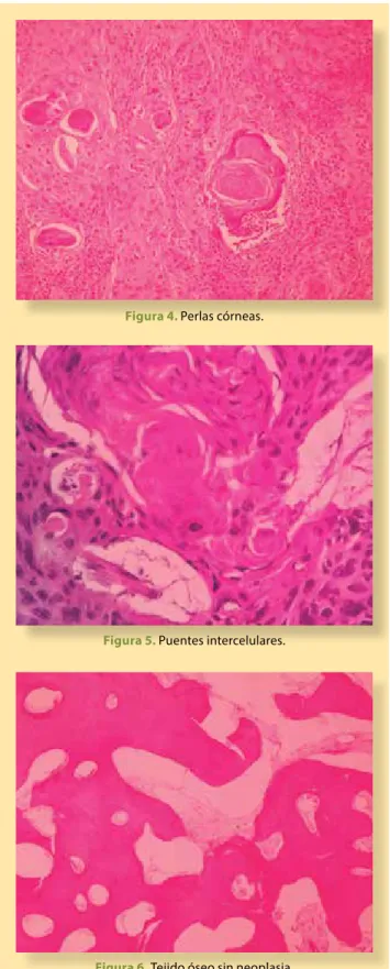 Figura 4.  Perlas córneas.