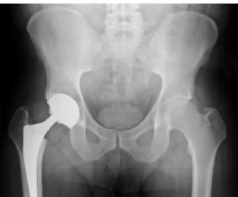 Figure 5.Calcium hydroxyapatite used to encourage and artificial hip to fuse  with the bone 