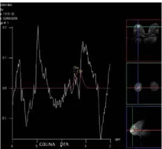Figura 17. Tomografía  por emisión  de positrones  (PET-CT) donde  se aprecia  cáncer mamario  izquierdo visible  en la tomografía  computada,  imágenes de  medicina nuclear  y la combinación  de ambas con  captación de la  glucosa marcada  (flechas largas