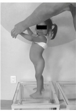 Figura 1.  Evidente hiperlordosis lumbar durante la  bipedestación y tendencia a la flexión de caderas.