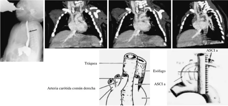 Figura 1. Caso 7. Paciente de 1 año 3/12, SEGD con compresión extrínseca esofágica secundaria a la presencia anillo vascular (flechas) mismo que es