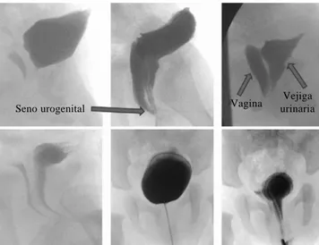 Figura 6. Imagen de laparoscopia donde se muestra el útero (U), ovario izquierdo (O) y ovotestis derecho (OT)