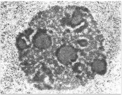 Figura 3. Morfología del nucléolo. Se aprecian los diferentes compartimentos del nucléolo: los  centros fibrilares (CF), el componente fibrilar denso (CFD), el componente granular (CG)  y los  intersticios nucleolares