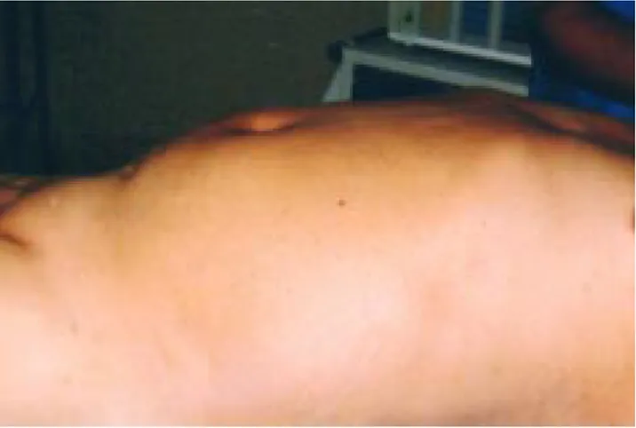 Figura 1. Paciente con masa pulsátil en mesogastrio y flanco izquierdo.