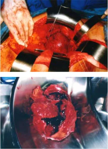 Figura 8. Reconstrucción con prótesis de dacrón con anastomosis aor- aor-toilíaca bilateral.
