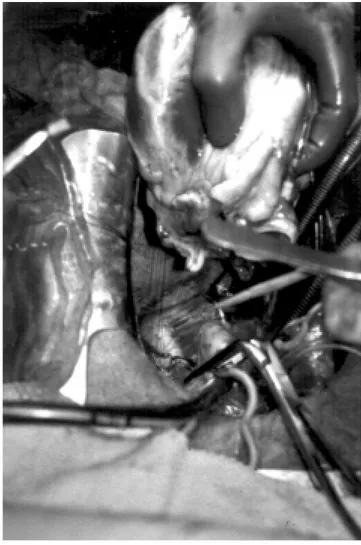 Figura 2. Pulmones procurados manteniéndolos inflados hasta su implante