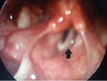 Figura 3. Tomografía computarizada de cuello; se aprecia una masa ti-