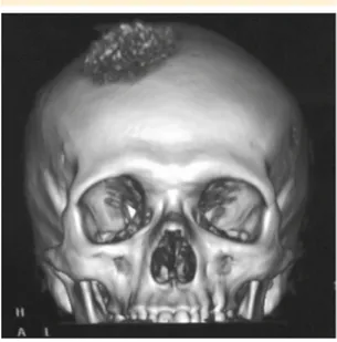 Figura 2.  Tomografía computada con vista anterior de  las estructuras óseas. Se aprecia una lesión infiltrativa  del hueso parietal y afección de la porción vertical del  hueso frontal; la tumoración tiene un componente de  tejidos blandos que protruye a 
