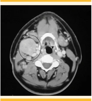 Figura 3.  Tomografía computada contrastada. Cáncer  de nasofaringe: se observa la lesión marcada  des-plazando la línea media e infiltrando los músculos  peritubarios.