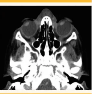 Figura 1.  Paciente con lesión en el dorso nasal.