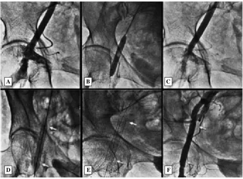 Figura 8. Comprobación del cierre vascular. A. La angiografía muestra extravasación de contraste en la zona de la arteriotomía