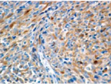 Figura 6. Inmunorreactividad con citoqueratina AE1/AE3 en células fusi-