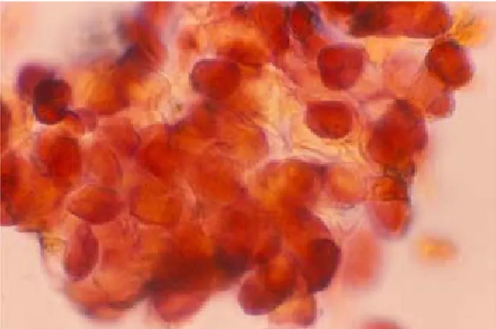 Figura 2. Molusco contagioso. Grupo de células epiteliales con