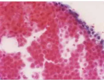 Figura 6. Células epiteliales benignas con características apocri-