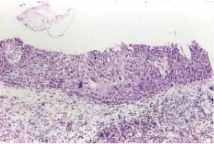 Figura 2. (H y E 10x). Cérvix uterino con neoplasia intraepitelial