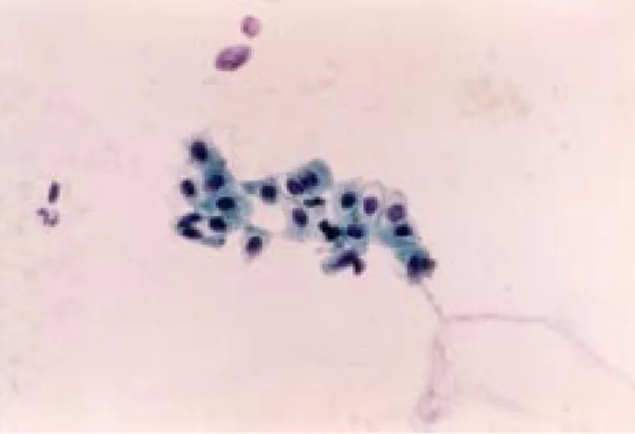 Figura 4. Extendido de uretra masculina que muestra células con alteraciones inflamatorias y bacterias (40X).