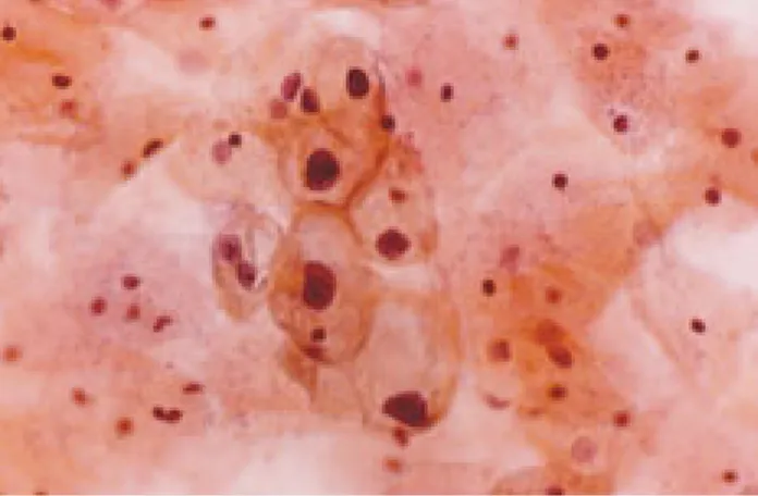 Figura 3. Lesión intraepitelial escamosa de alto grado (carcino- (carcino-ma in situ)
